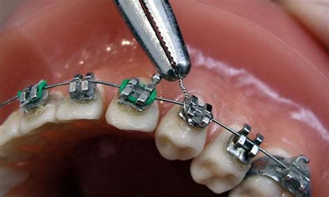 ligadura metalica brackets|bracket dental precio.